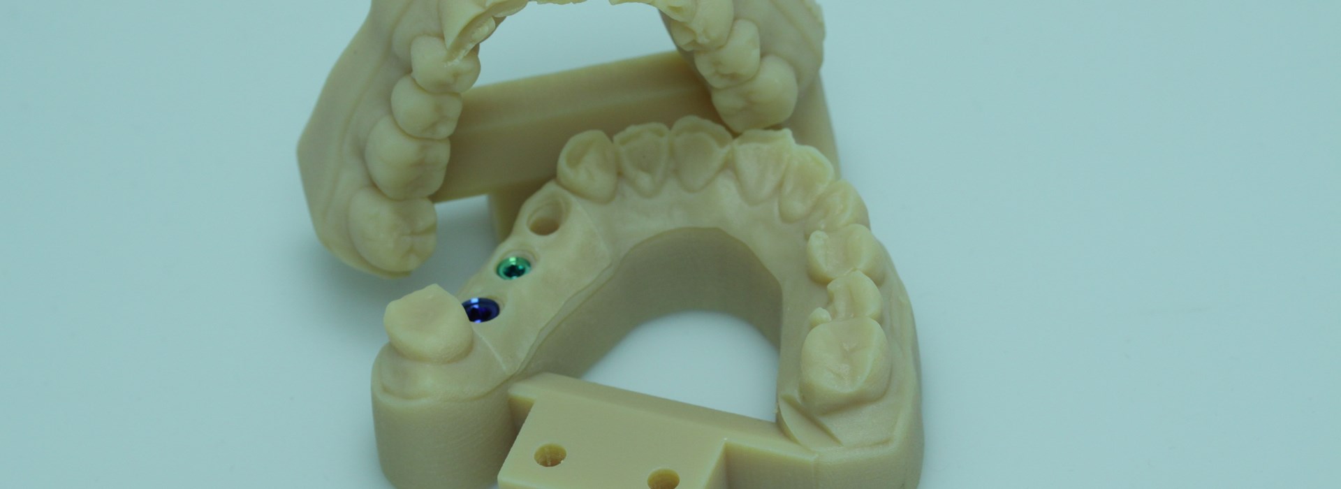 3d printed dental model with prosthetic guides