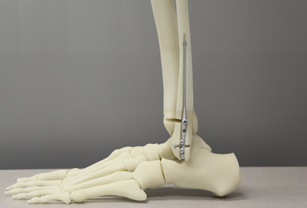 3D Printed Bone Model