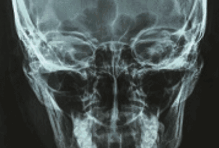 Cranioplastica con esito positivo di una donna di 23 anni con tecnologia di stampa 3D.