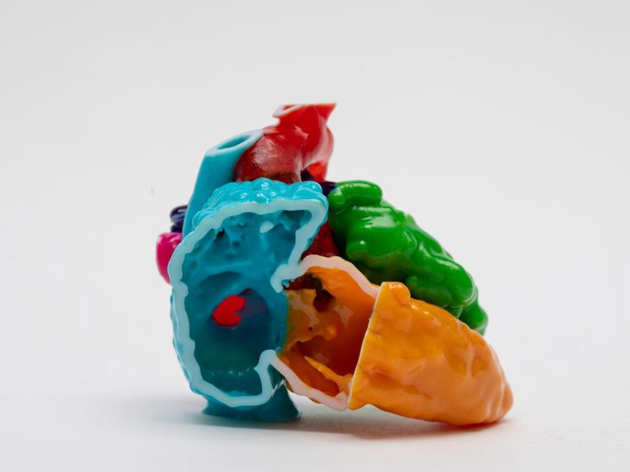 &nbsp;3D model of the heart of a 5-day-old infant with congenitally corrected transposition of the great arteries with a large ventricular
septal defect and severe subaortic stenosis. (AO – aorta, ASD – atrial septal defect, RA – right atrium, LV – left ventricle, MV – mitral valve,
VSD – ventricular septal defect)