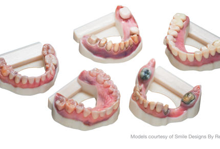 Dental models