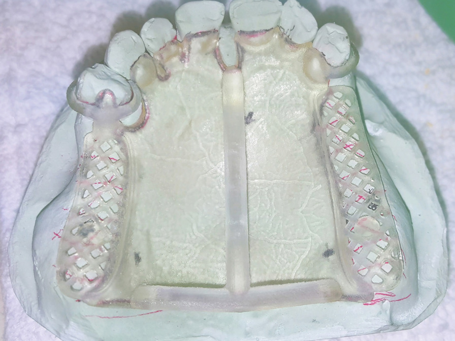 3d Printed partial framework on dental implant. 