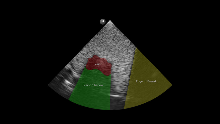 Breast lesion labeled