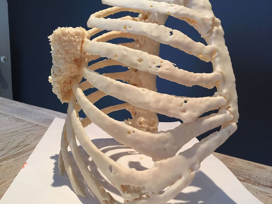 This patient-specific model of a thoracic wall tumor was 3D printed
using the Stratasys Fortus 450mc.