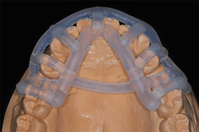3D printed surgical guide on dental model prior to surgery.