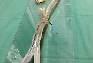 Transparent 3D printed model of a patient-specific aortic arch used by the University Hospital Mainz to practice complex endovascular surgeries.