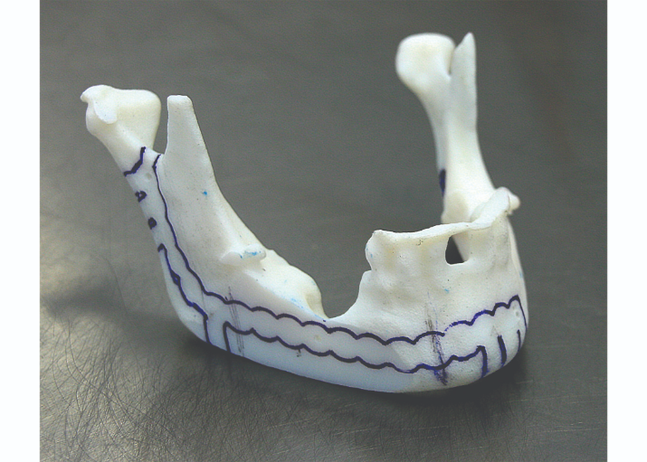 For facial and jaw reconstruction, 3D printed surgical models save three to four hours in the OR.
