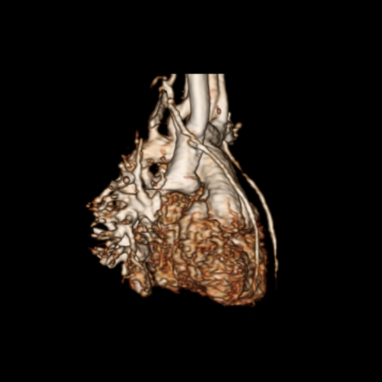 Patient cardiac MRI with and without contrast.
