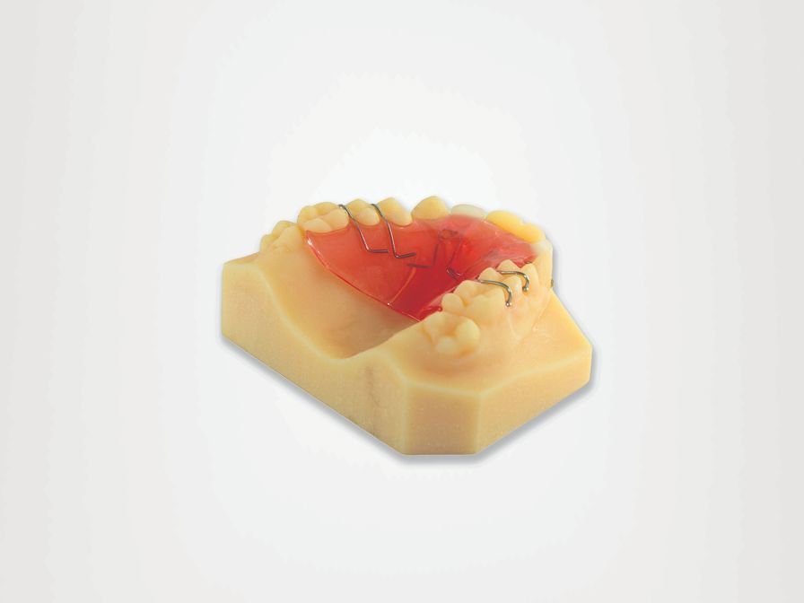 A 3D printed model for labial indirect bonding.<br><br>