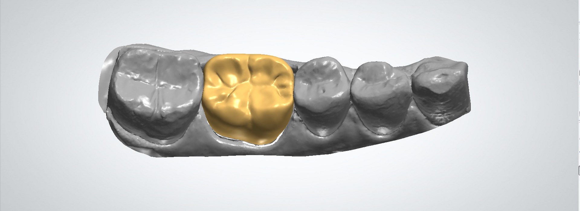 3d printing dental implants