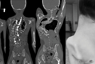 curvature of the spine due to Scoliosis