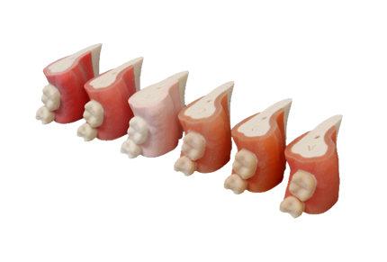 individual 3D printed anatomical teeth by Stratasys