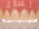 Stratasys TrueDent Denture closeup of internal structures.