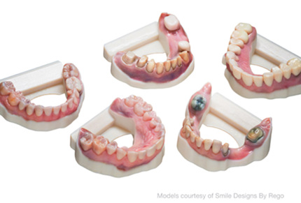 Why print dental models in color?