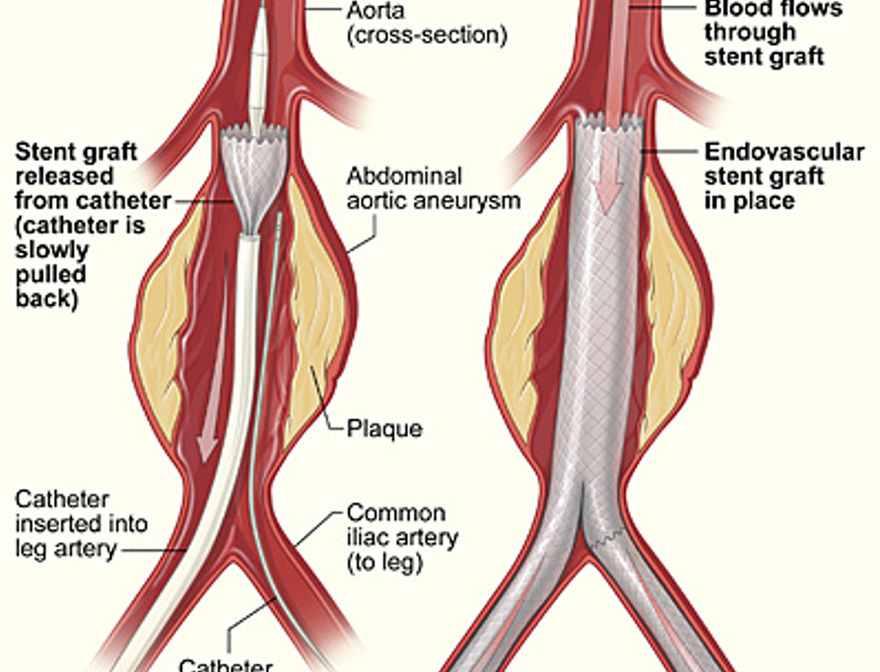 Stent insertion diagram.