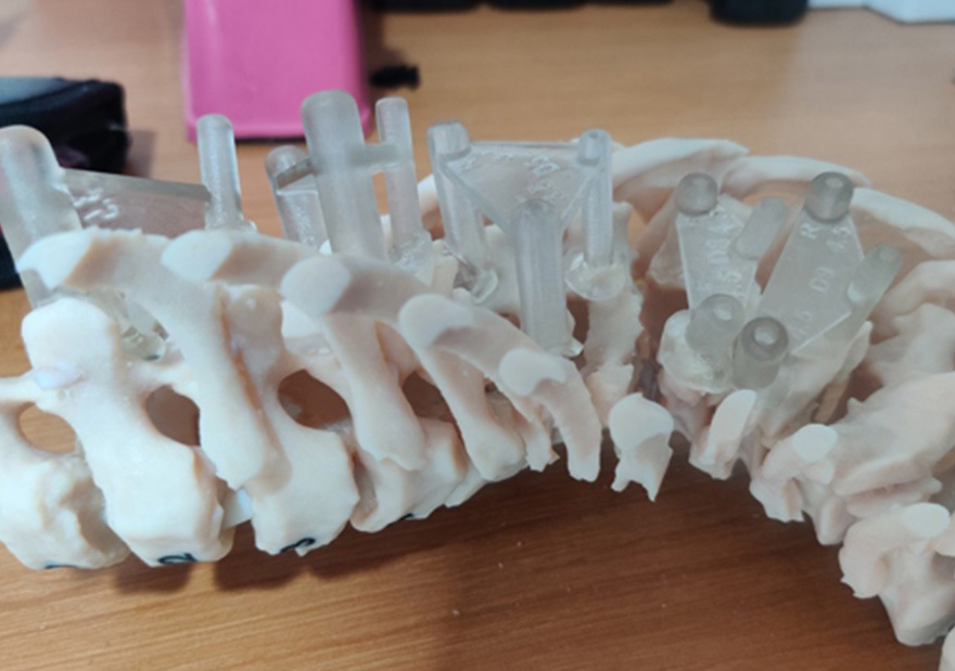 Aakash Healthcare Uses Stratasys’ J5 MediJet to create 3D Printed Pre-Surgical Model and Jigs to  Correct Scoliosis Deformity