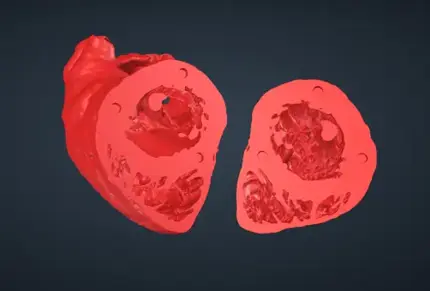 TG Mid Papillary SAX View VHL file image for 3d printing