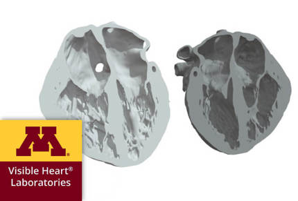 3d model echocardiography UofM Minnesota | Stratasys Direct