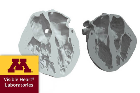 3d model echocardiography UofM Minnesota | Stratasys Direct