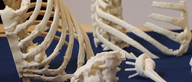 3D printed models of the thoracic wall enable surgeons to plan, perform and perfect the resection on the 3D model ahead of the actual surgery.