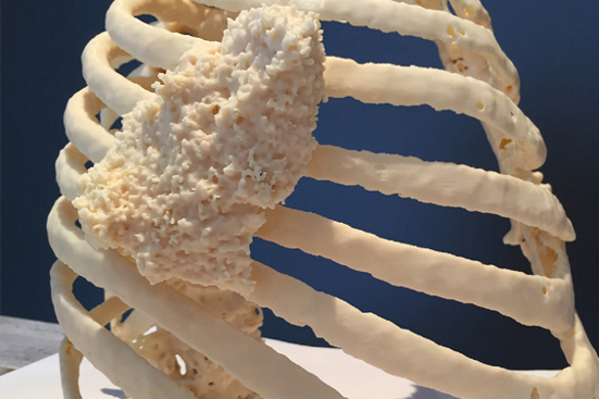 3D printed ribcage model showing thoracic wall tumor for surgical planning