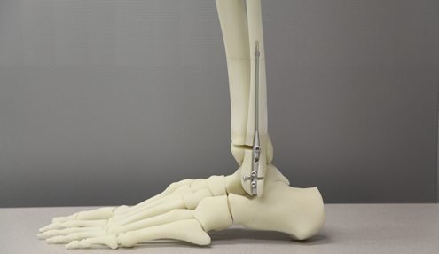3D Printed Bone Models | Sonoma Case Study | Stratasys Direct